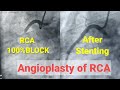 Primary Angioplasty Of RCA Stenting Of RCA 100 Blcoked RCA 