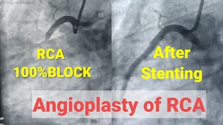 Primary Angioplasty of RCA, Stenting of RCA, 100% blcoked RCA screenshot 3