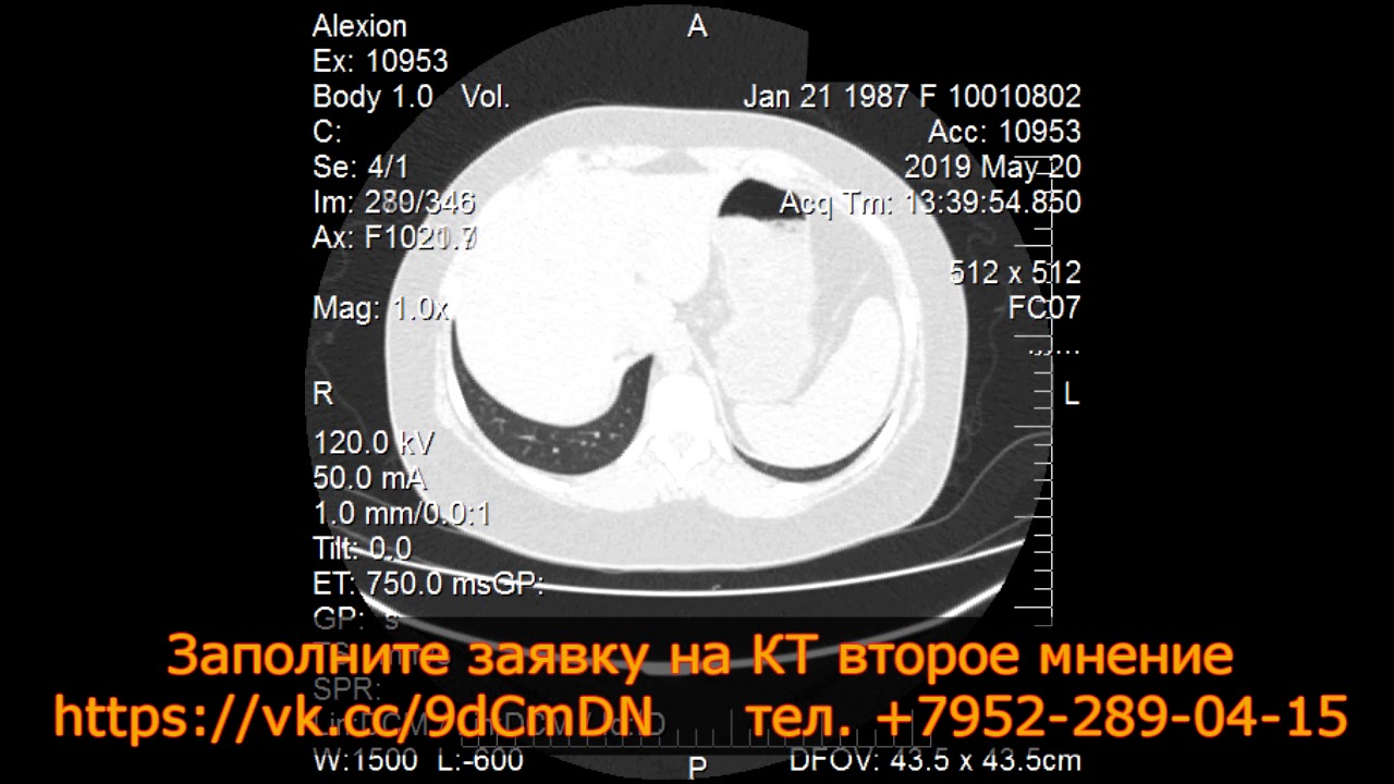ПРАВОСТОРОННЯЯ ПНЕВМОНИЯ с симптомами матового стекла на расшифровке ...