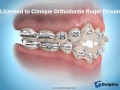 Port dlastiques en orthodontie