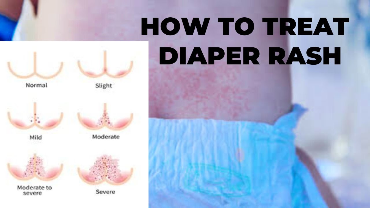 How to treat diaper rash ,डायपर रैश का इलाज कैसे करें - YouTube