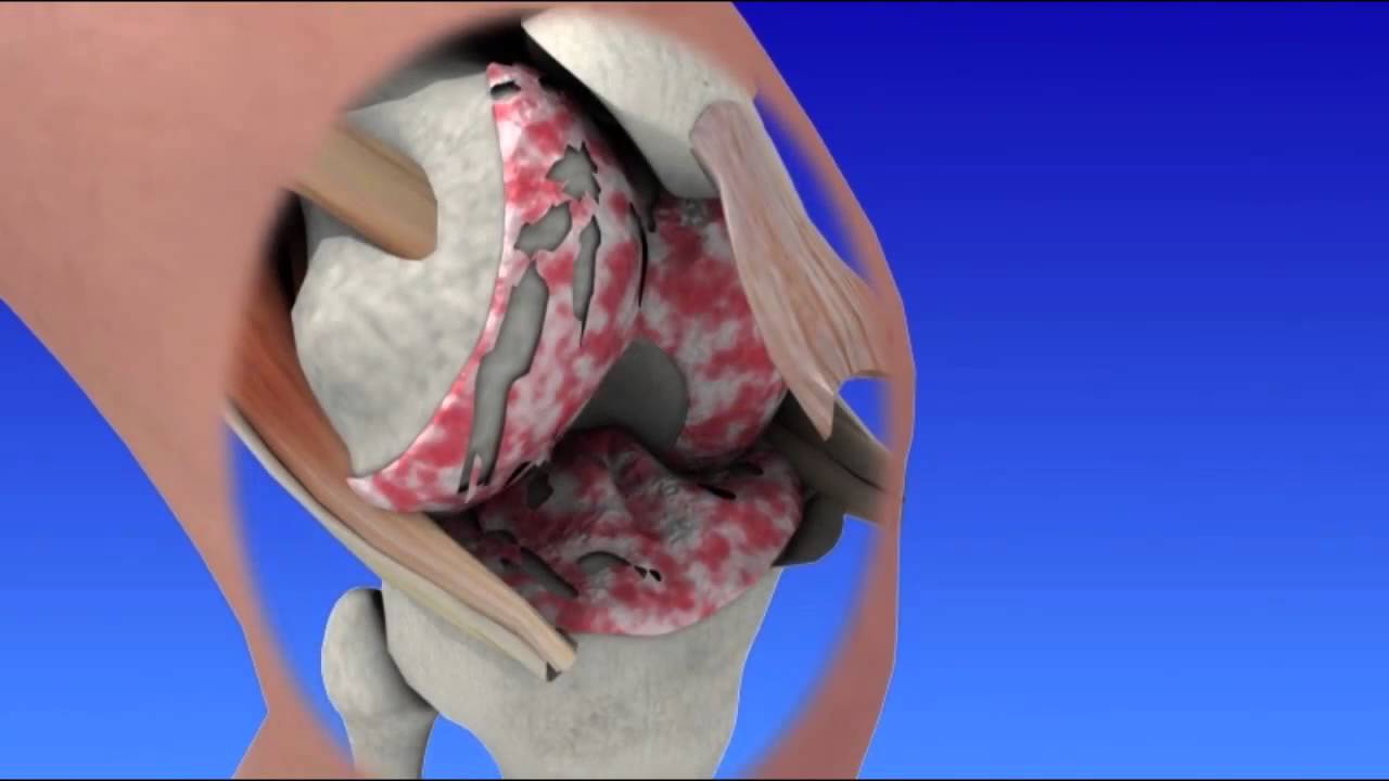Total Knee Replacement YouTube