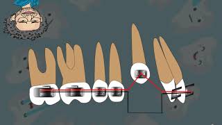 Mechanics Of Buccal Canine Alignment Piggyback