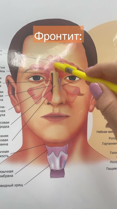 Синуситы наглядно в иллюстрациях#медицина#лор#москва - YouTube