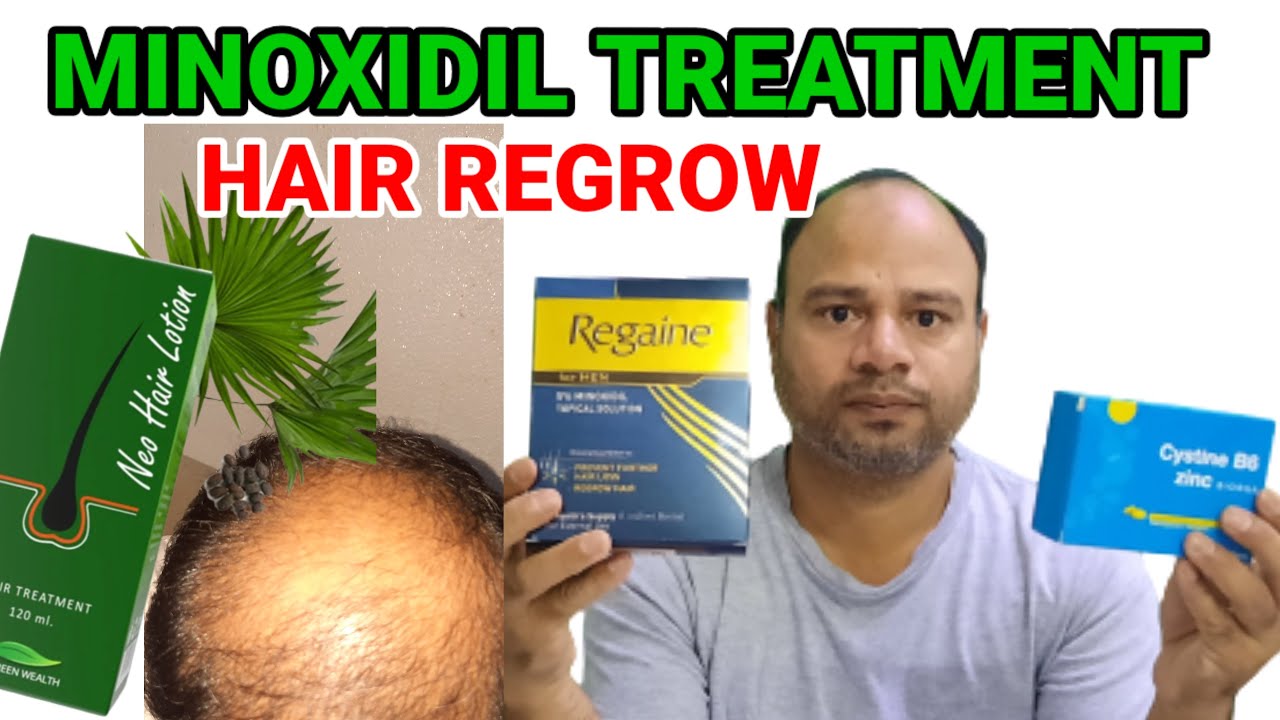 Neo Hair Lotion Minoxidil Treatment And Transplant YouTube