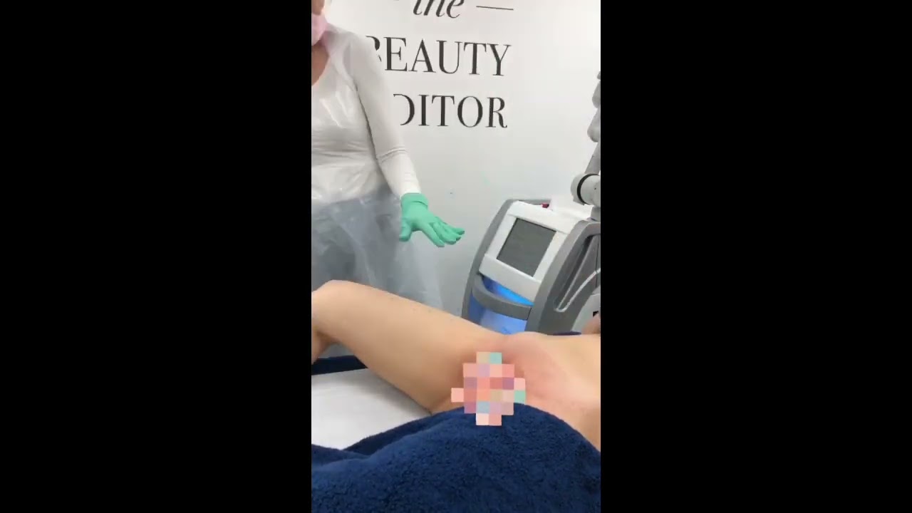 Brazilian laser hair removal