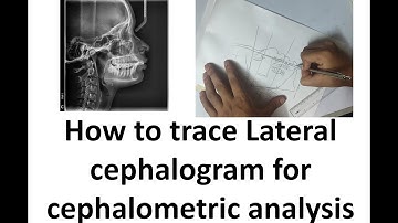 How to do cephalometric tracing for lateral cephalogram cephalometric analysis