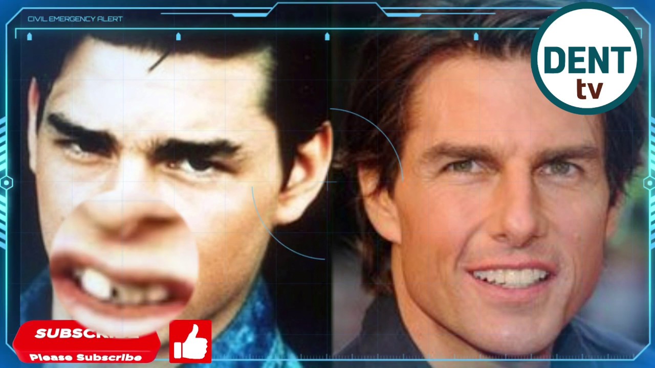 Tom Cruise Dental Midline Shift: Teeth Surgery And Braces To Treat Middle  Tooth(Before And After) - Youtube
