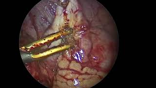 Complicated laparoscopic appendectomy in children