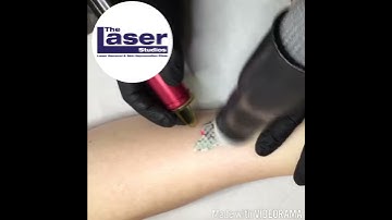 Excellent response to the first session of Laser Tattoo Removal with the Alex Trivantage