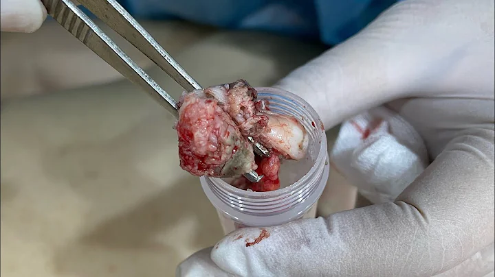 大顆背部粉瘤切除 美麗新城診所 莊禮謙醫師 Big Epidermal Cyst Excision, Dr George - 天天要聞