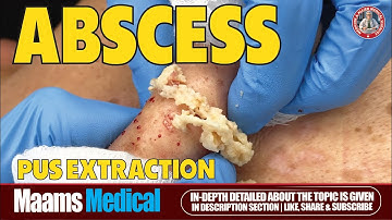 How to Extract an Inflamed Abscess From a Cyst | Abscess Drainage & Cyst Removal Tutorial