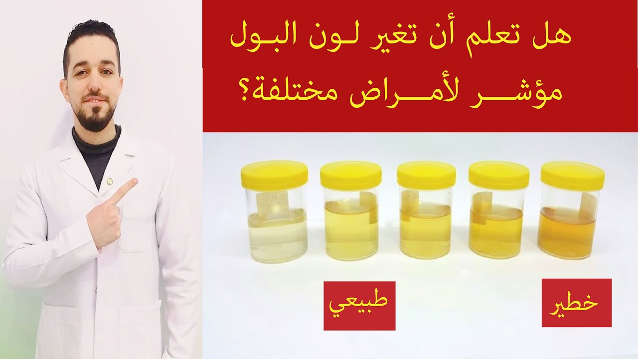 لون البول | تغير لون البول وعلاقته بأمراض الكبد وحصوات الكلى والمرارة ...