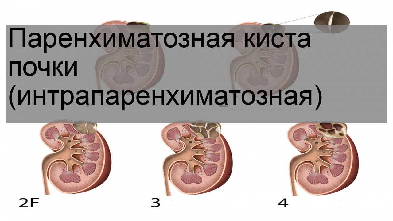 Киста в почке лечение у взрослых женщин. Паренхиматозная киста почки. Интрапаренхиматозная киста почки. Интрапаренхиматозная киста. Кисты почек классификация.