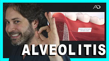 ¿Cómo curar la alveolitis rápido?