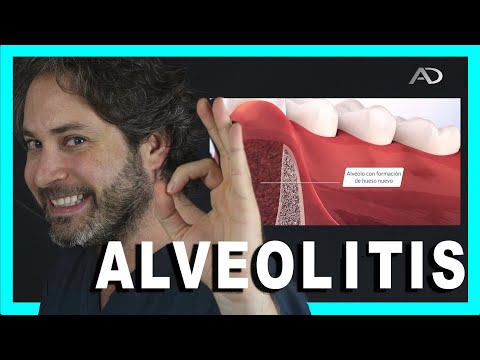 Video: ¿Se curará la alveolitis por sí sola?