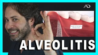 ALVEOLITIS SECA CAUSAS Y SOLUCIONES.Infeccion después de SACAR una MUELA