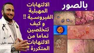 بالصور الالتهابات المهبلية الفيروسية و كيف تتخلصين تماما من الالتهابات المتكررة / د.محمد خليل
