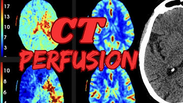 CT perfusion for acute strokes