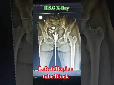 Left fallopian tube