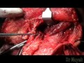 Modified radical neck dissection type 3 mrnd by dr sandeep nayak bangalore