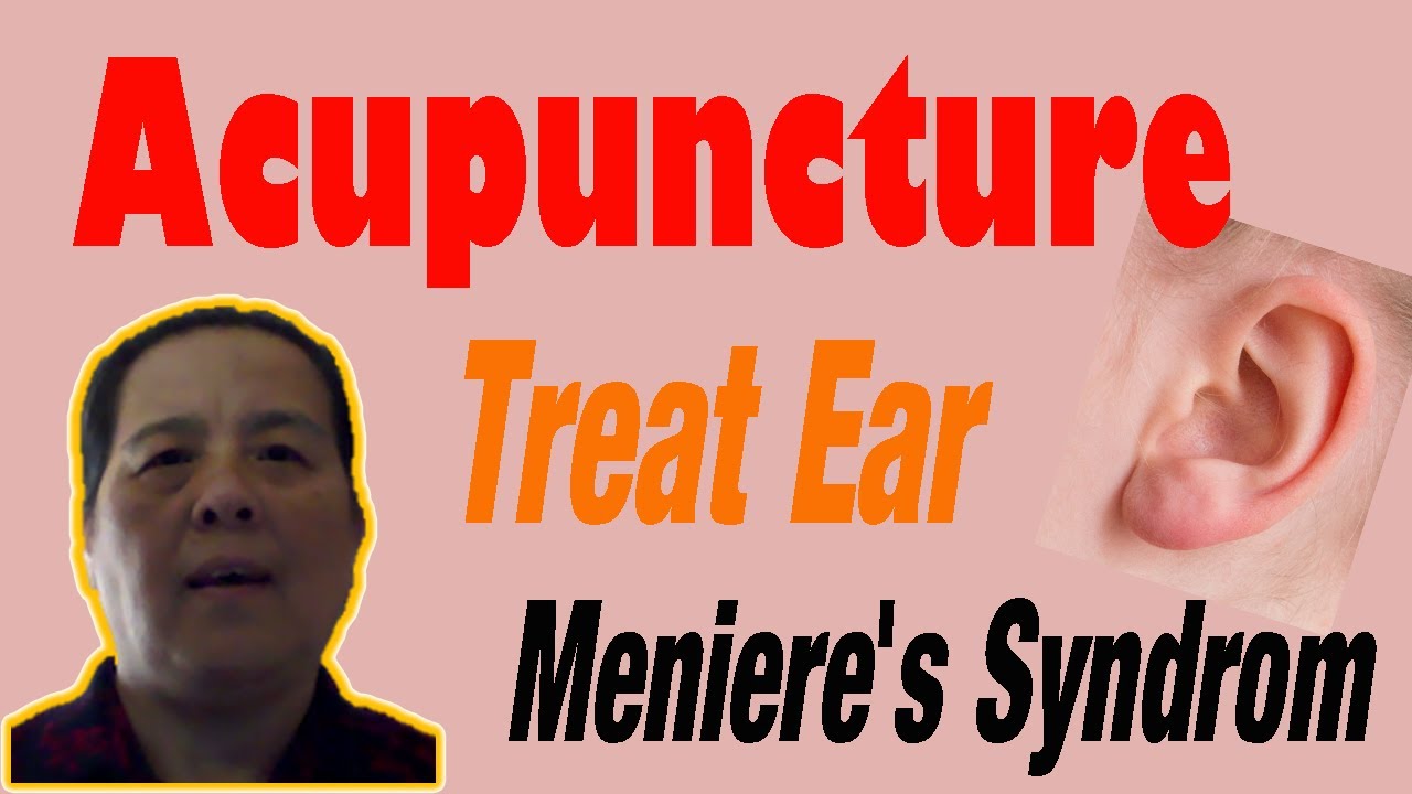 Acupuncture Treat Meniere's Syndrome YouTube