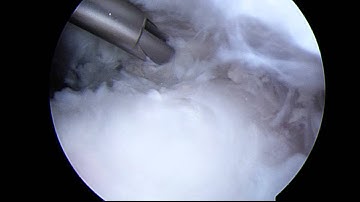 Suprascapular Nerve Decompression Case - Part 1