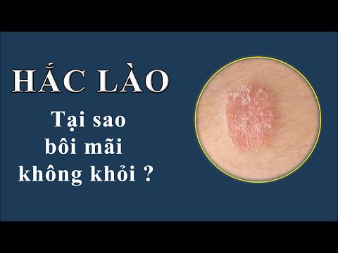 Hắc lào tại sao bôi mãi không khỏi ? Cách điều trị dứt điểm Hắc Lào như thế nào