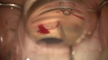 iStent inject (my first case)