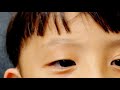 【事件です】コジの眉毛がなくなりました…