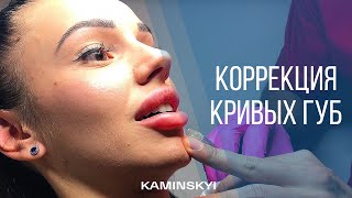 Исправление асимметрии губ JUVEDERM VOLIFT | 14.02.2017 ★ EDGAR KAMINSKYI