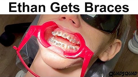 How Braces Are Put On