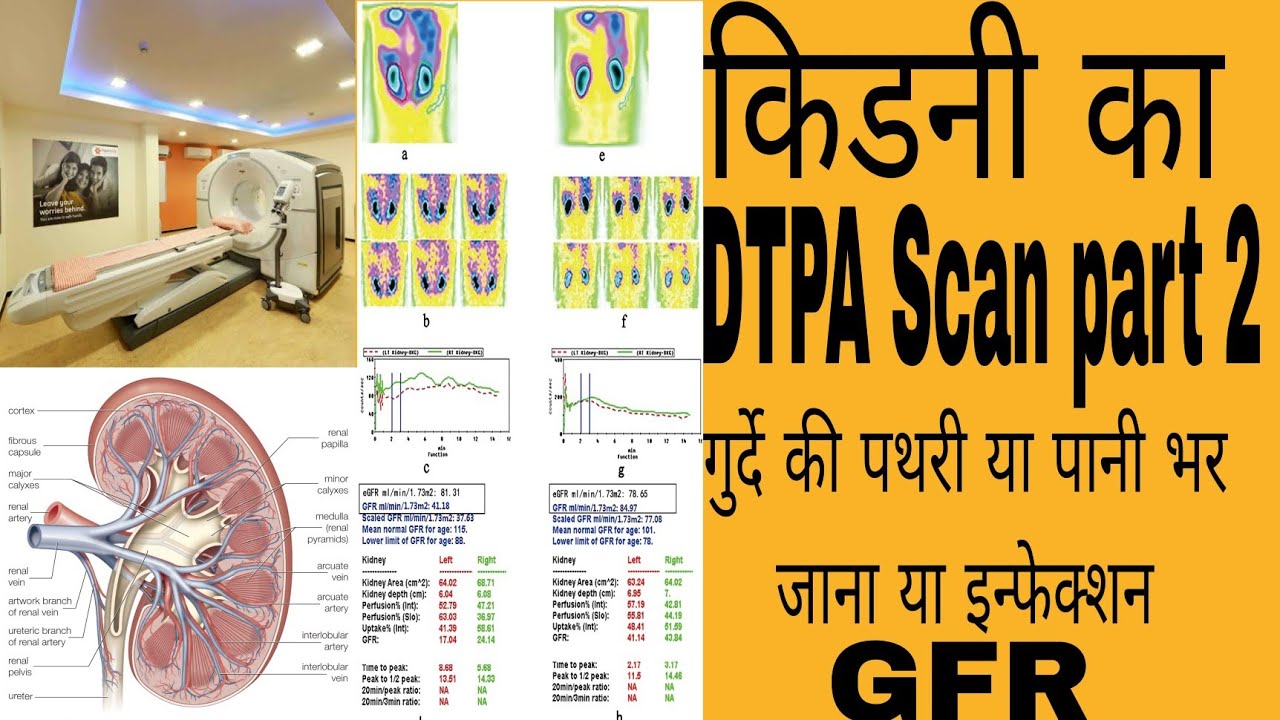 kidney-ka-dtpa-scan-part-2-hindi-usg-ct-scan-abdomen-durde-ki-jaach