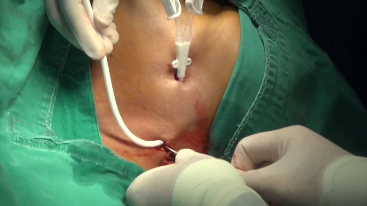 Intra Op Problem Dislodge Of Guidewire During Palindrome Cath Intra Op Problem Dislodge Of Guidewire During Palindrome Cath