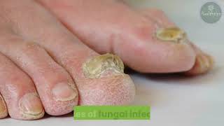 Psoriasis vs. Fungal Infection: Tips for Identification and Treatments