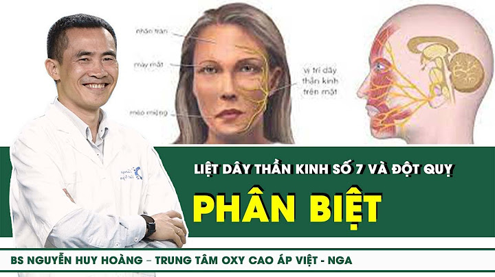 Dấu hiệu bị lác là do liệt thần kinh nào năm 2024