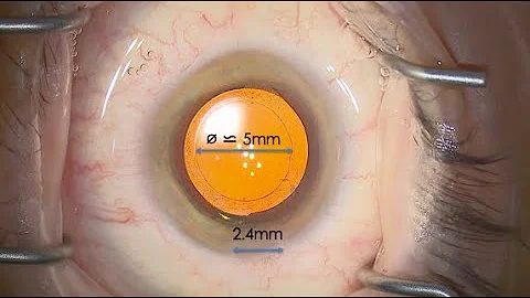 Deconstructing cataract surgery 8 - Capsulorhexis