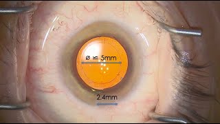 Deconstructing cataract surgery 8 - Capsulorhexis