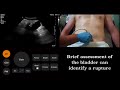 Ultrasound tutorial fast focused assessment with sonography for trauma scan  radiology nation