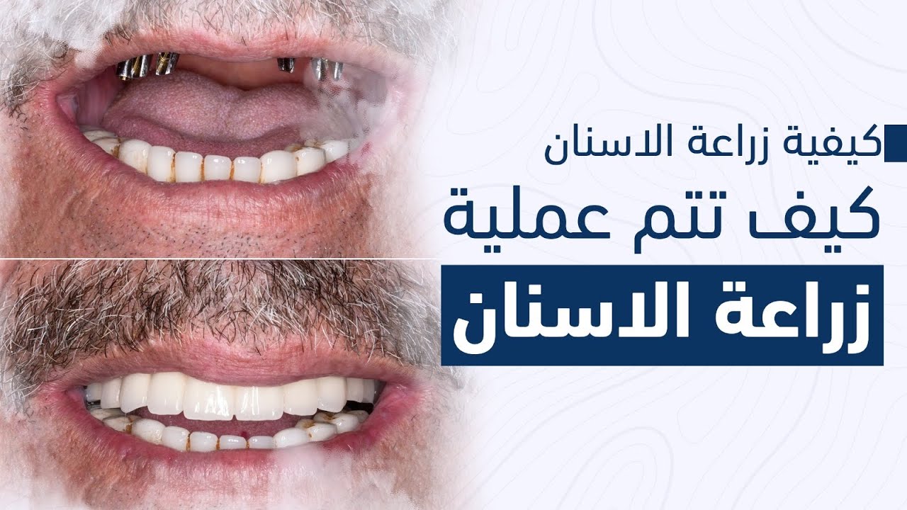 كيفية زراعة الاسنان | كيف يتم عملية زراعة الاسنان