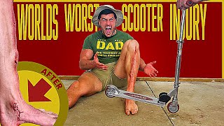Creating the WORST SCOOTER INJURY of all Time | Bodybuilder VS The Worst Pain Ever Experiment