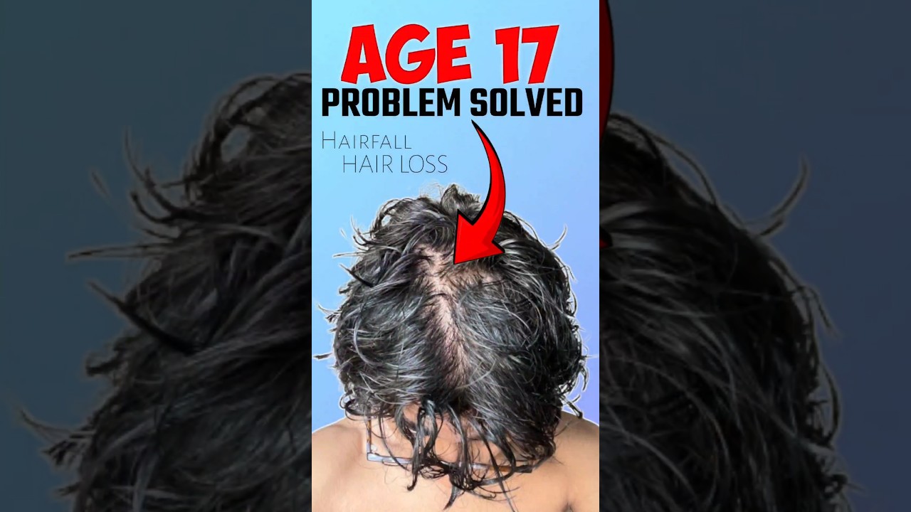 Hairloss at Teenage #hairloss #ytshorts #shortsvideo