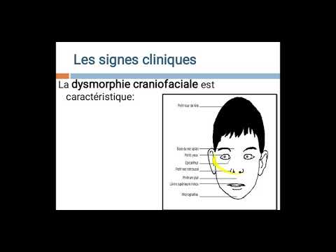 Maladies chromosomiques Pr Ag BELARBI