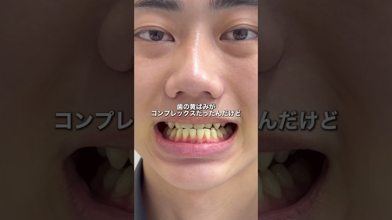 SNSで話題の歯磨き粉　口元の清潔感上がってめっちゃ良かった！　#歯 #ホワイトニング #歯磨き粉 #黄ばみ #清潔感 pr