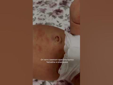 Пуповина отваливается сама на 7-10 день после родов.Акушерка пупок не ...