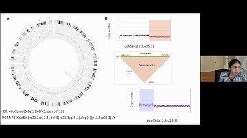Optical Genome mapping for Clinical Evaluation of Genomic Complexity in Myelodysplastic Syndromes