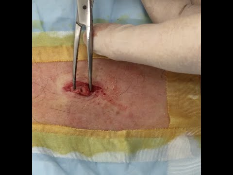 It's A St. Paddy's Day Back Cyst!  Part 2