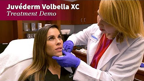 Juvederm Volbella XC Treatment by Andrea Flynn PA-C