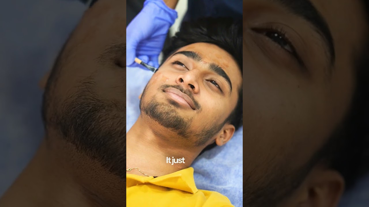 Lactic peel treatment at Maynee Clinic Chennai — click to play