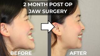 2 Months After Jaw Surgery | Before &amp; After Results | Underbite Vlog 11